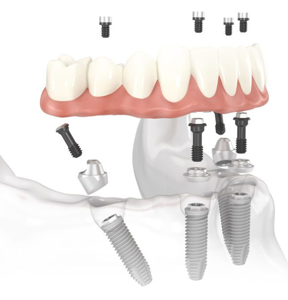 Fixed-Hybrid-Prosthesis illustration