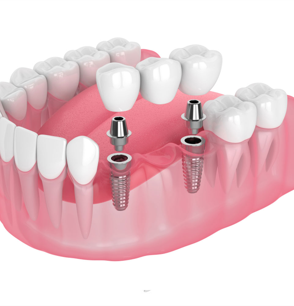 Implant-Supported-Crown-and-Bridge illsutration