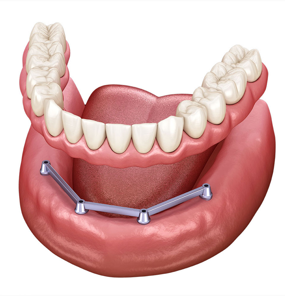 Removable-Implant-Supported-Overdenture illustration
