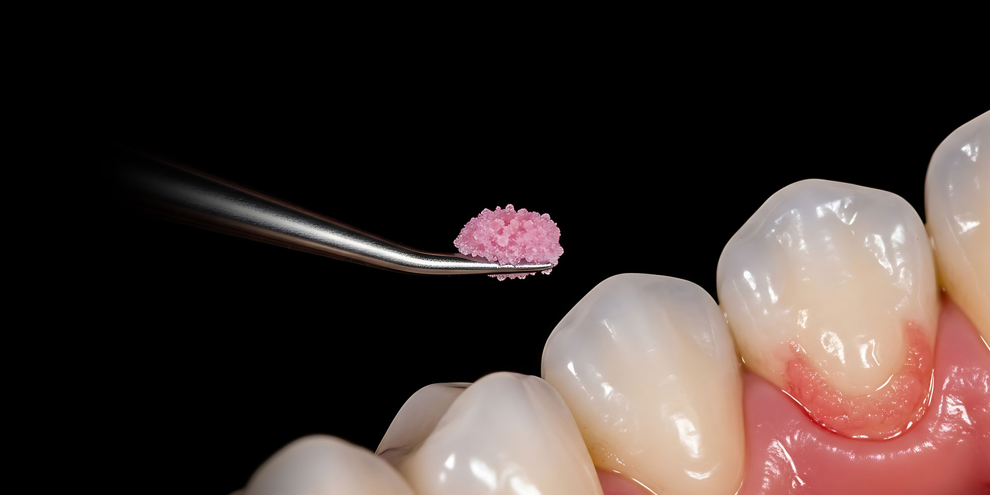 close up of grafting material for dental gum grafting treatment