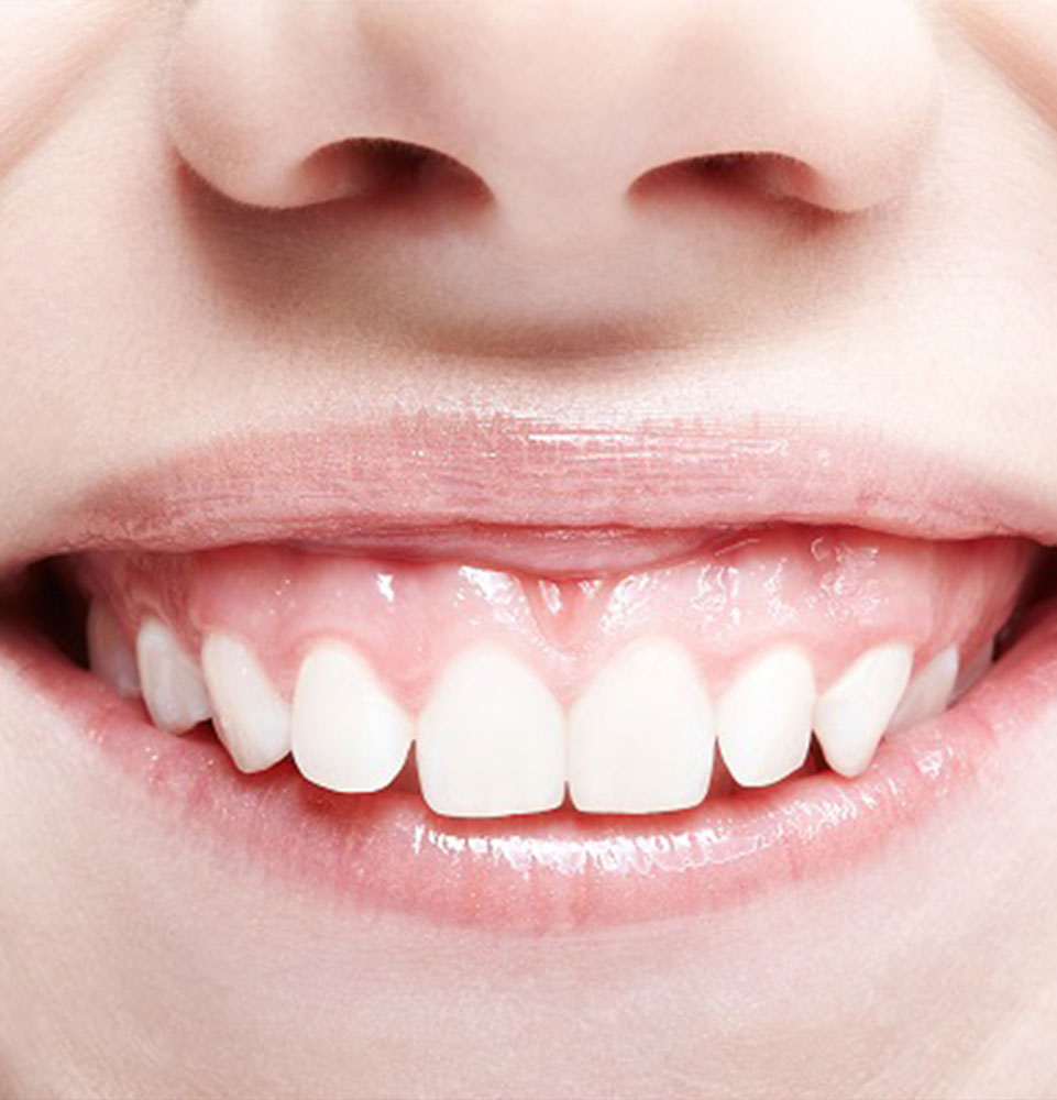 close up of patient with gummy smile