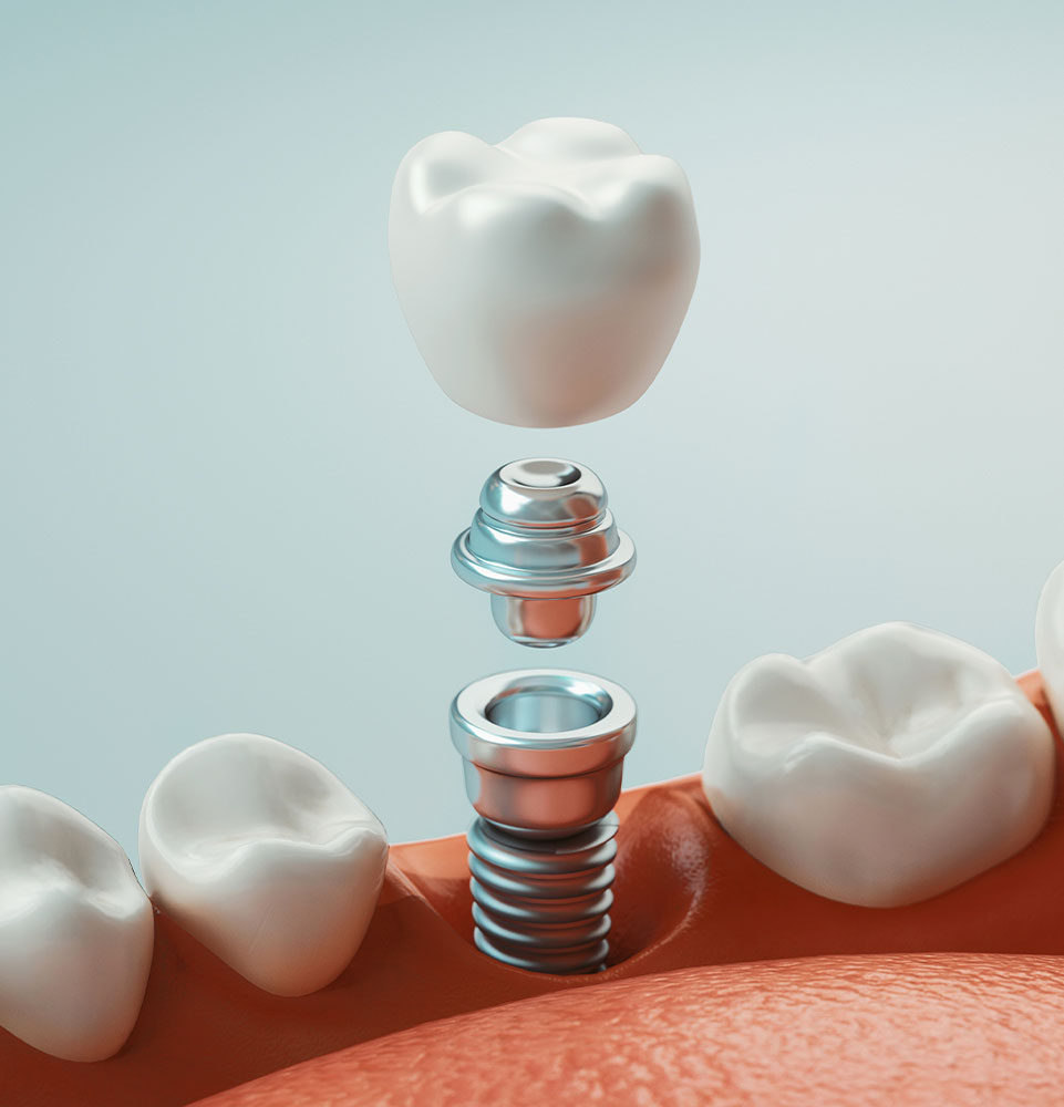Dental Implants