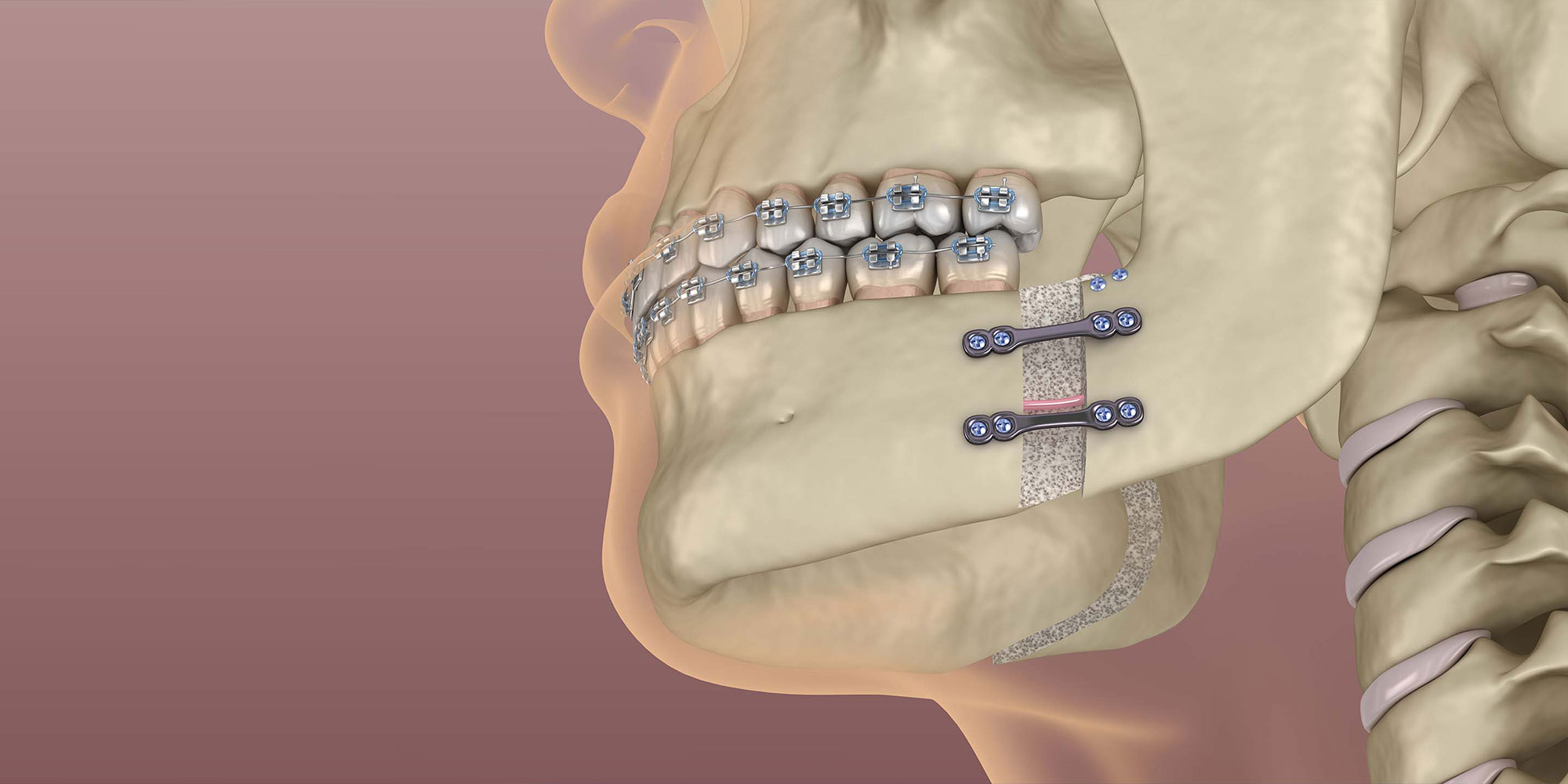 orthodontic surgery illustration
